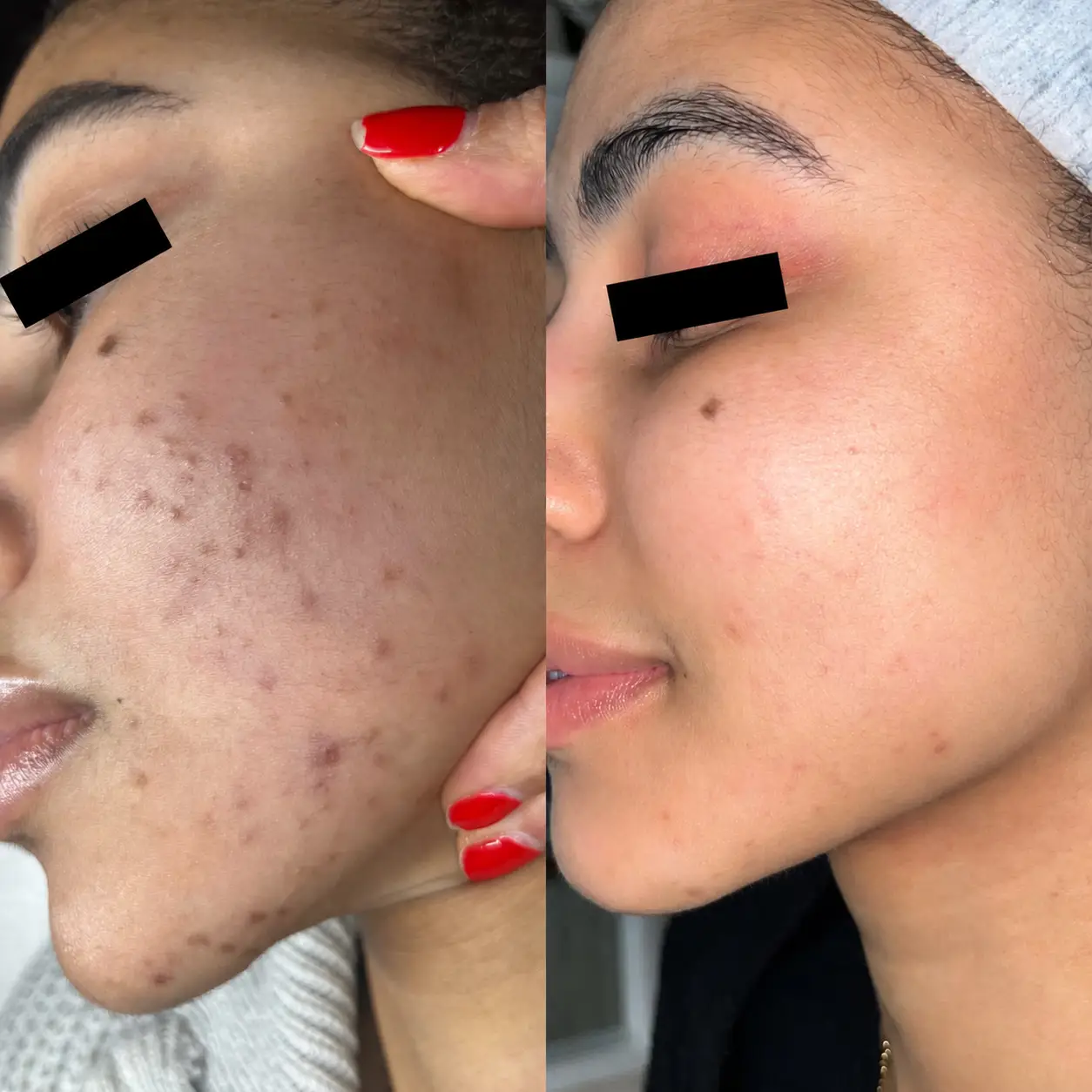 Before and after side-view photos showing fewer cheek and chin breakouts and less visible post-acne discoloration