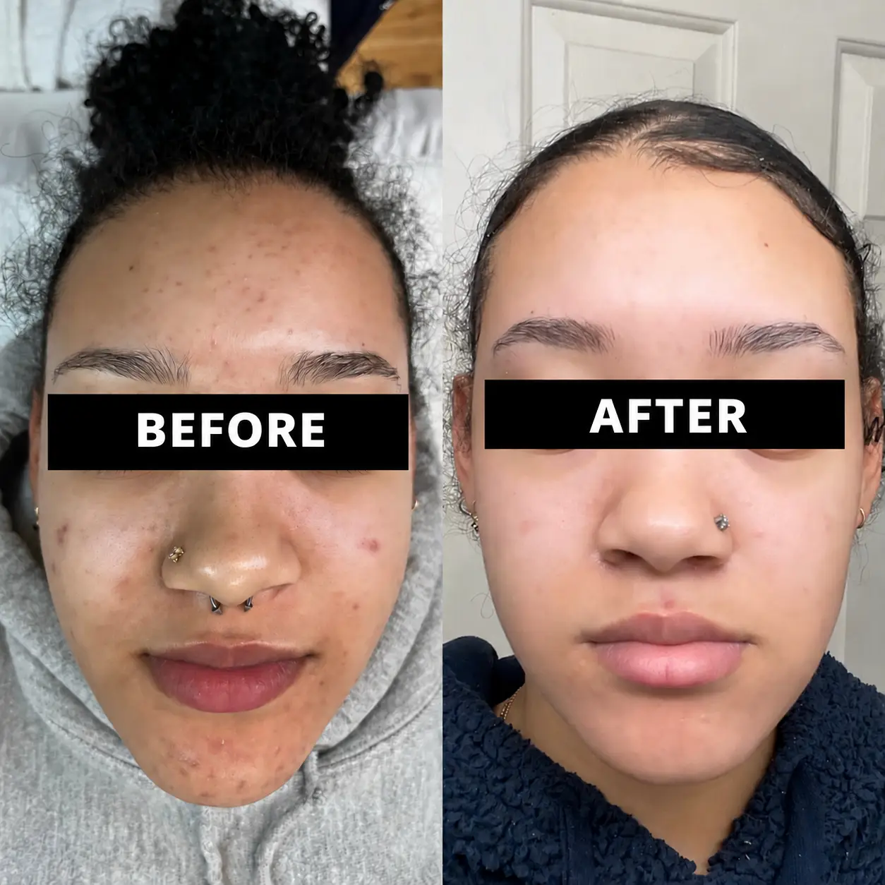 Before and after photos showing changes in acne and post-acne dark marks