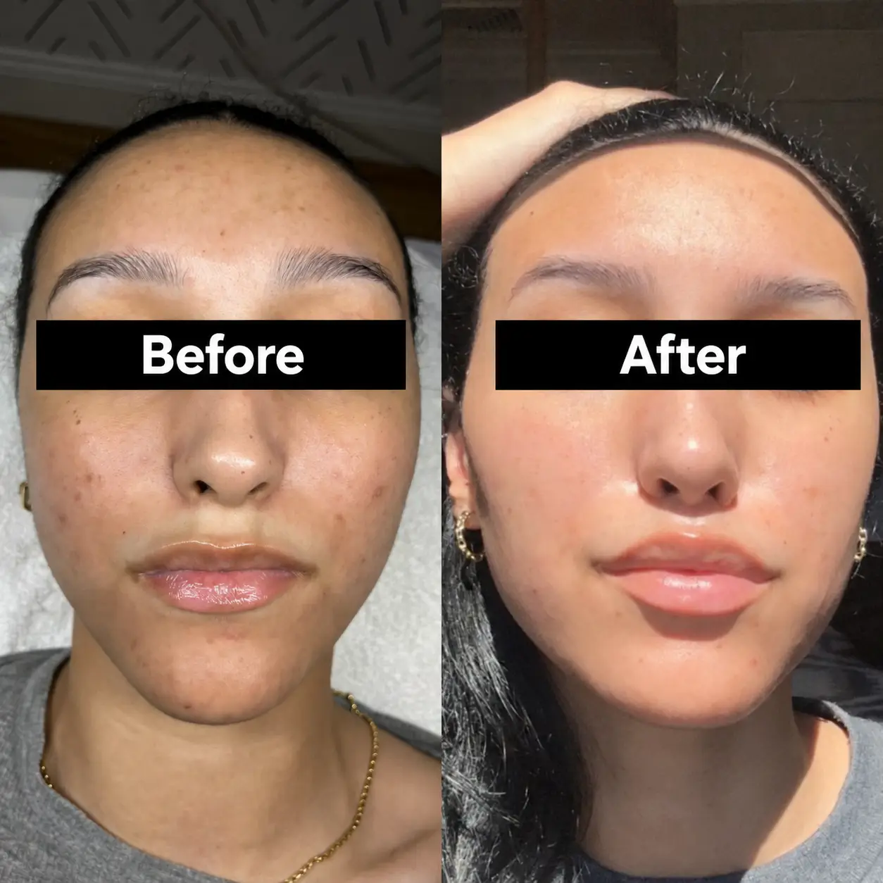 Before and after photos showing changes in facial dark spots and uneven skin tone