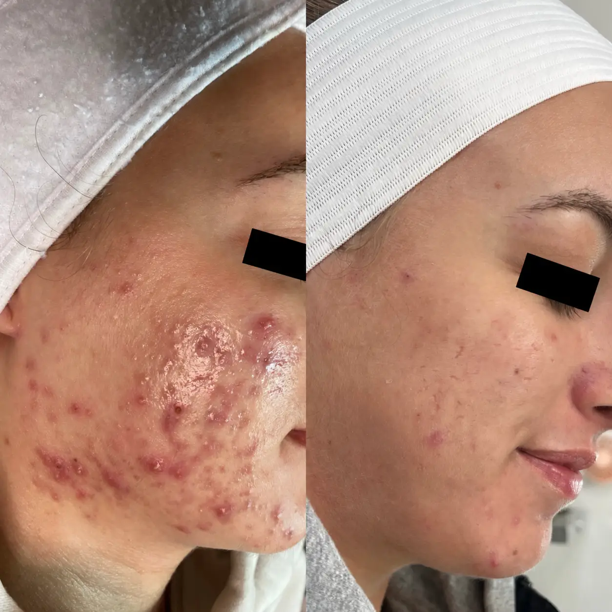 Before and after cheek photos showing fewer visible breakouts and a smoother-looking skin surface