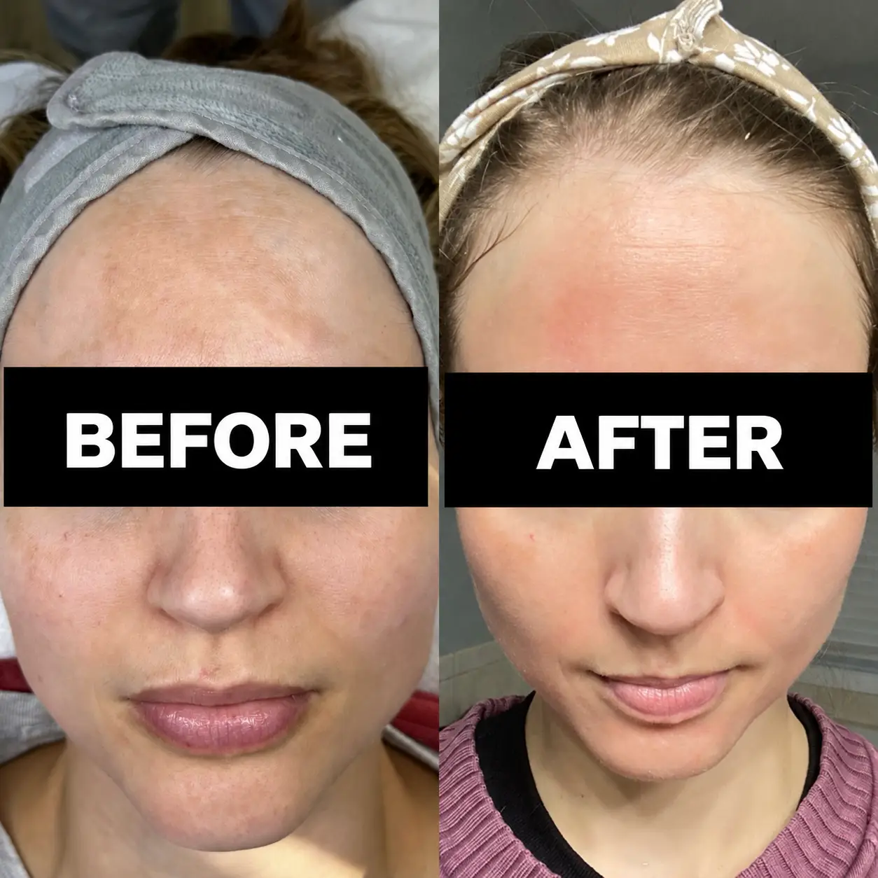 Before and after photos showing changes in the appearance of forehead hyperpigmentation