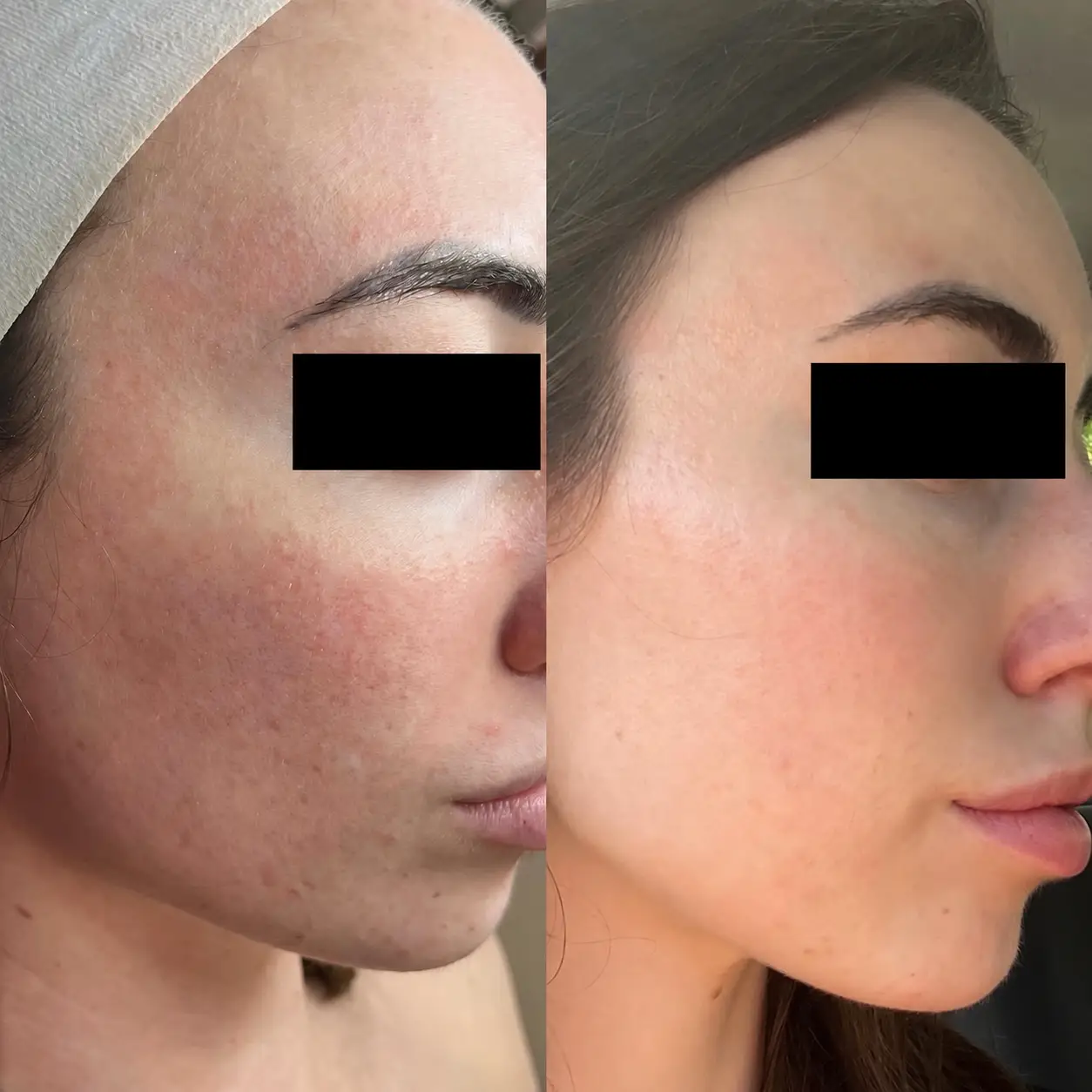 procell microchanneling for skin rejuvenation