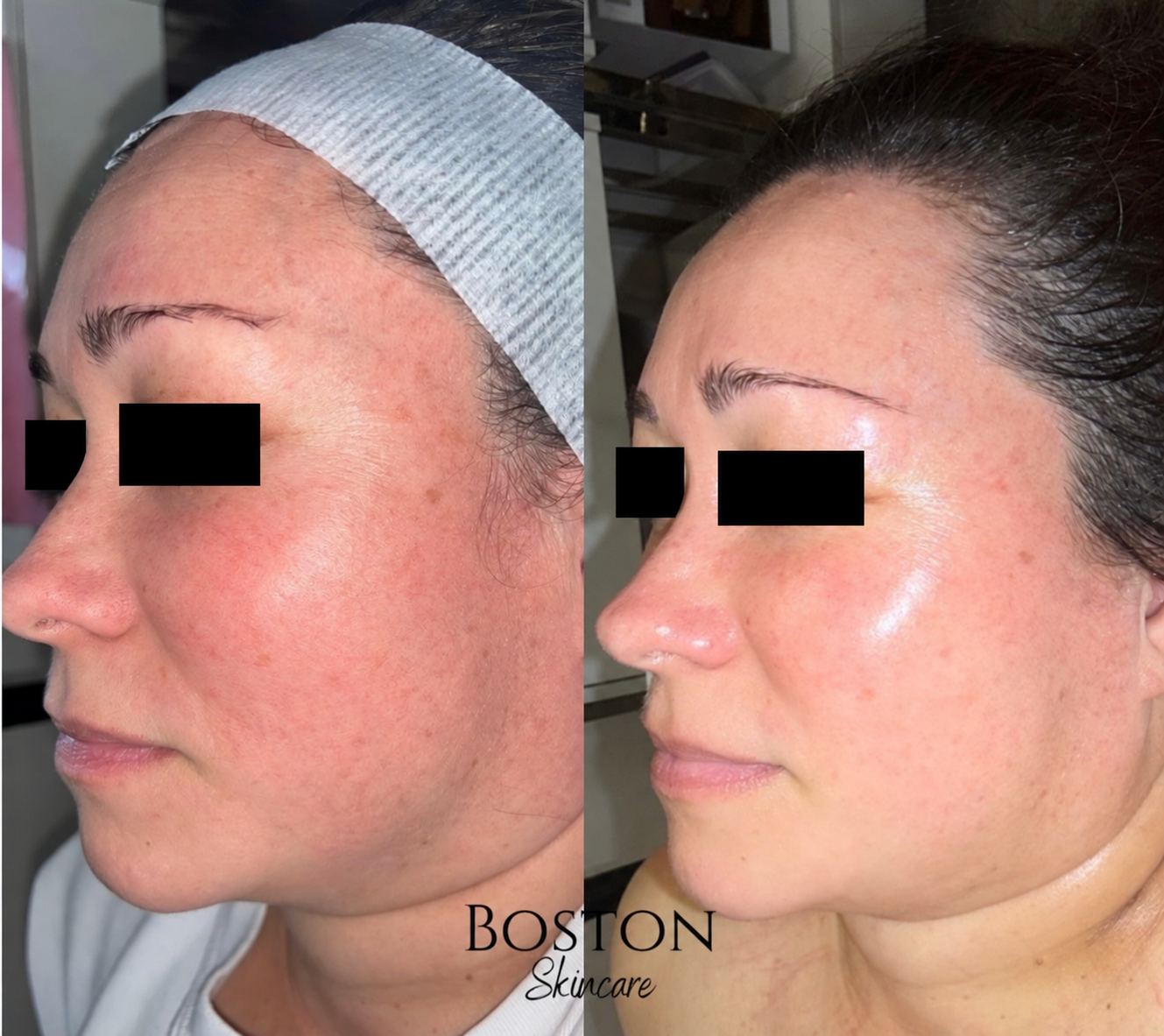 procell microchanneling for skin rejuvenation