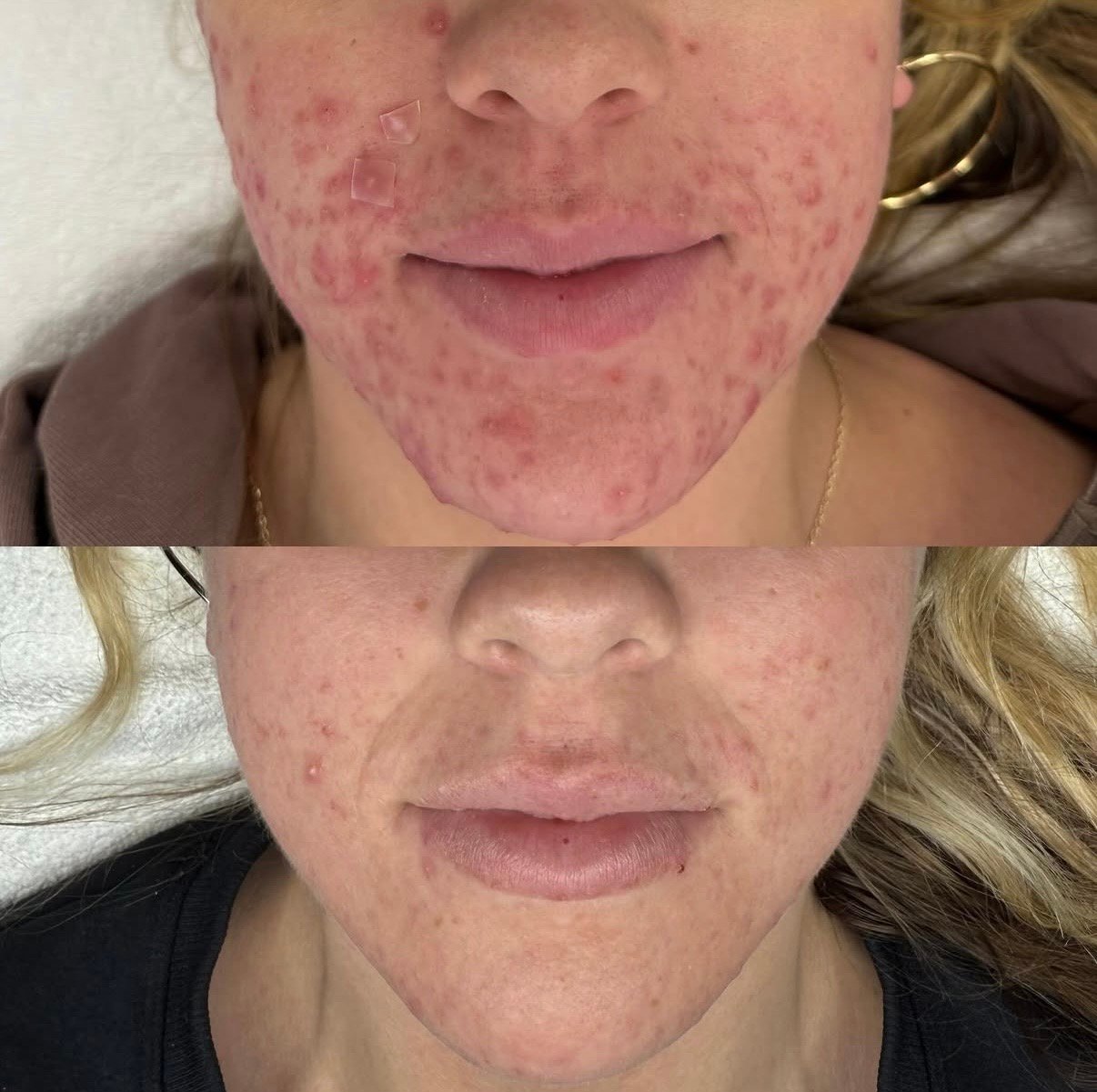procell microchanneling with acne bootcamp to help with acne scarring