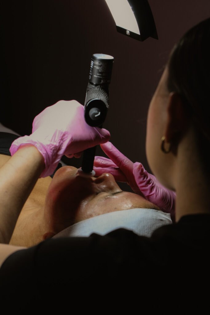 priscilla performing procell microchanneling for acne scarring and uneven texture at boston skincare in saugus MA