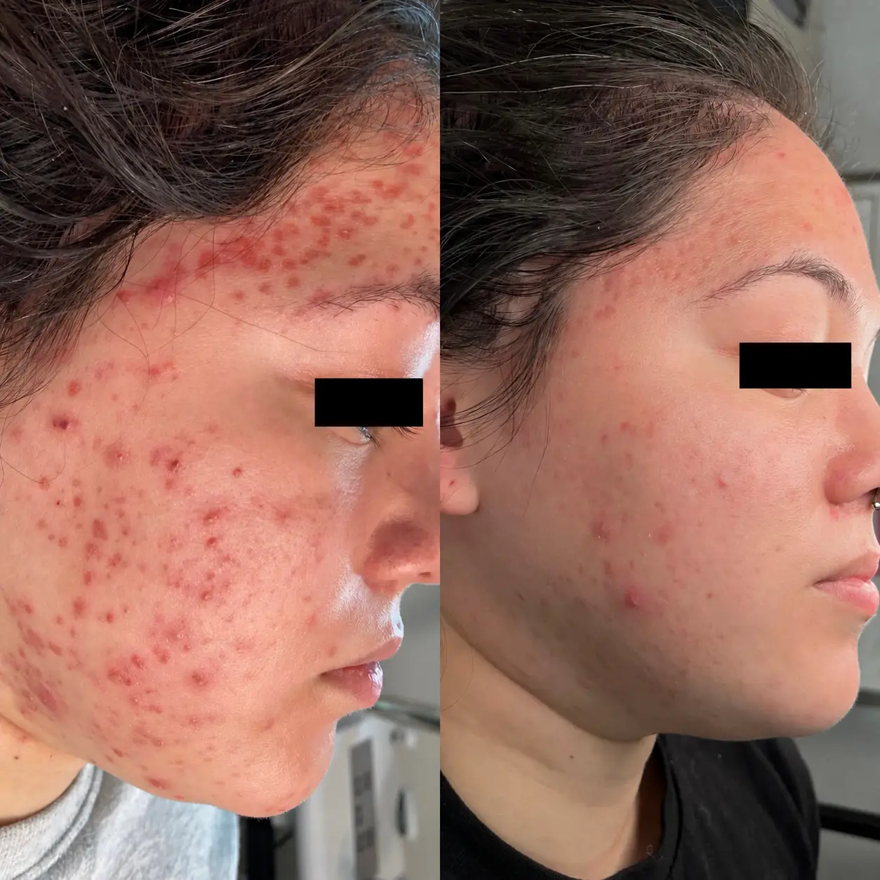 Before and after side-view photos showing fewer cheek breakouts and reduced visible redness