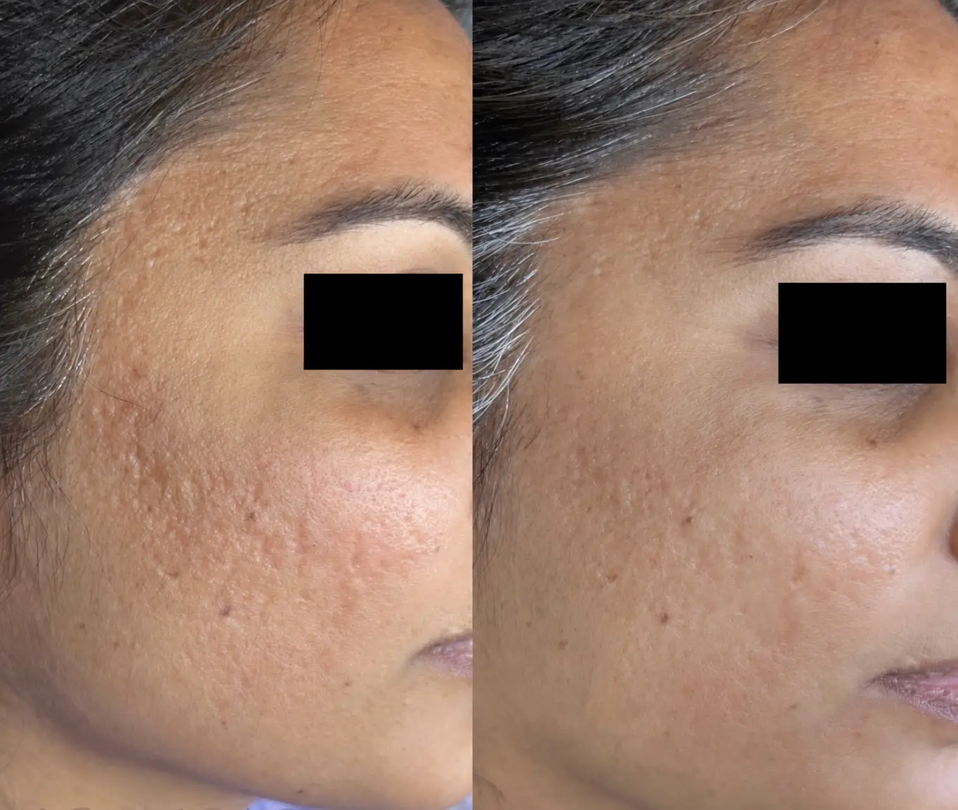 client had procell microchanneling microneedling done for acne scarring