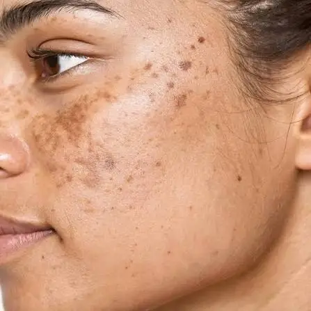 Close-up of facial hyperpigmentation showing dark patches and uneven skin tone on the cheek.